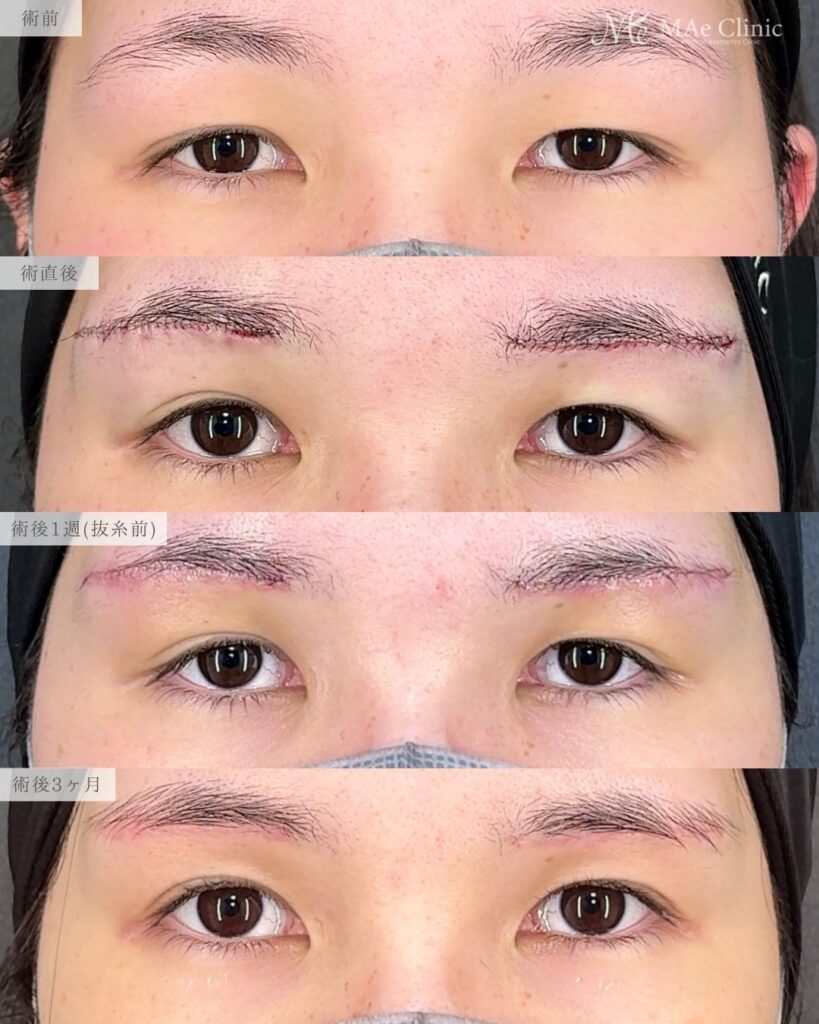眉下リフト（眉下切開） ROOF切除 眼輪筋切除 術後3ヵ月症例 前之園健太医師