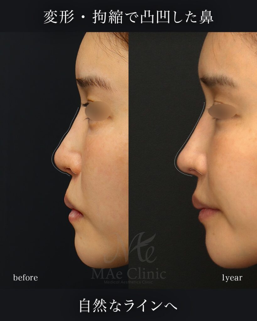 鼻中隔延長（肋軟骨） 鼻尖形成 鼻尖軟骨移植 隆鼻（肋軟骨） 鼻孔縁下降 猫貴族手術 前田翔医師症例写真