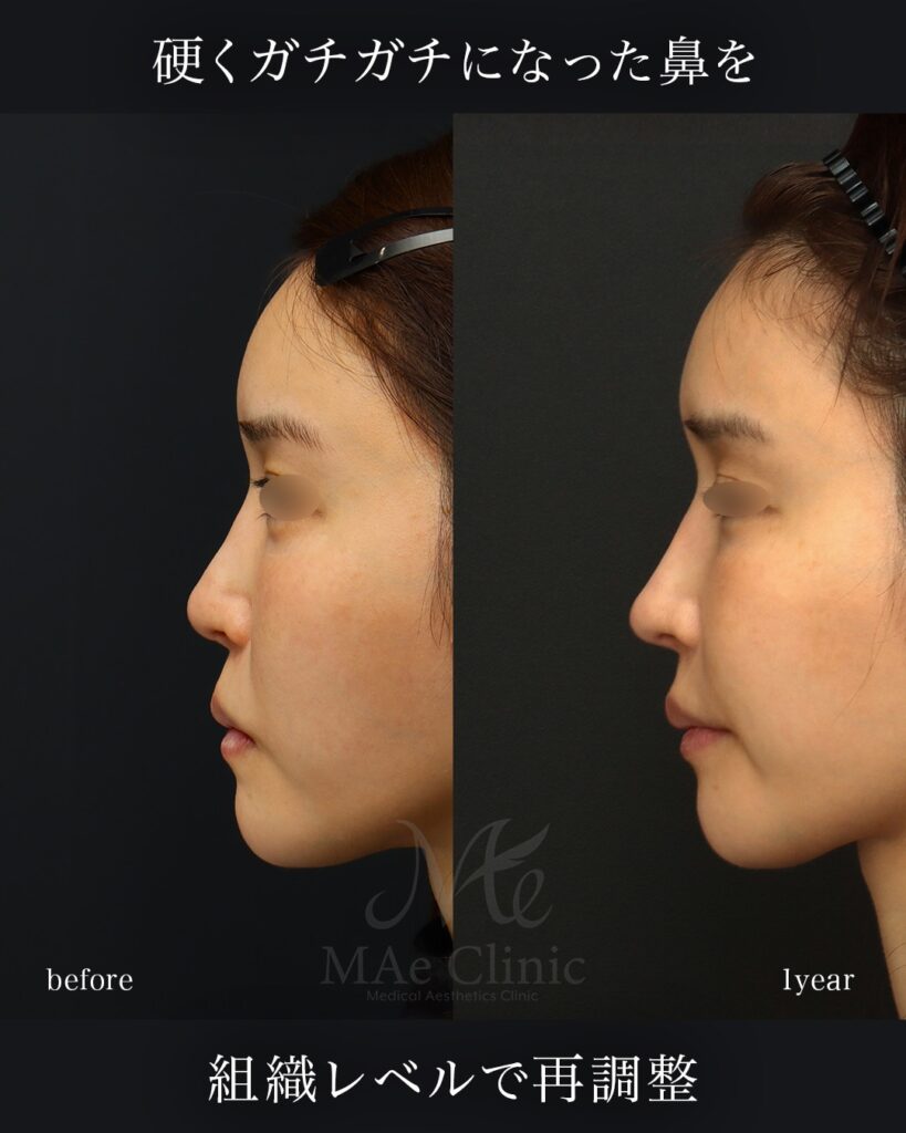 鼻中隔延長（肋軟骨） 鼻尖形成 鼻尖軟骨移植 隆鼻（肋軟骨） 鼻孔縁下降 猫貴族手術 前田翔医師症例写真