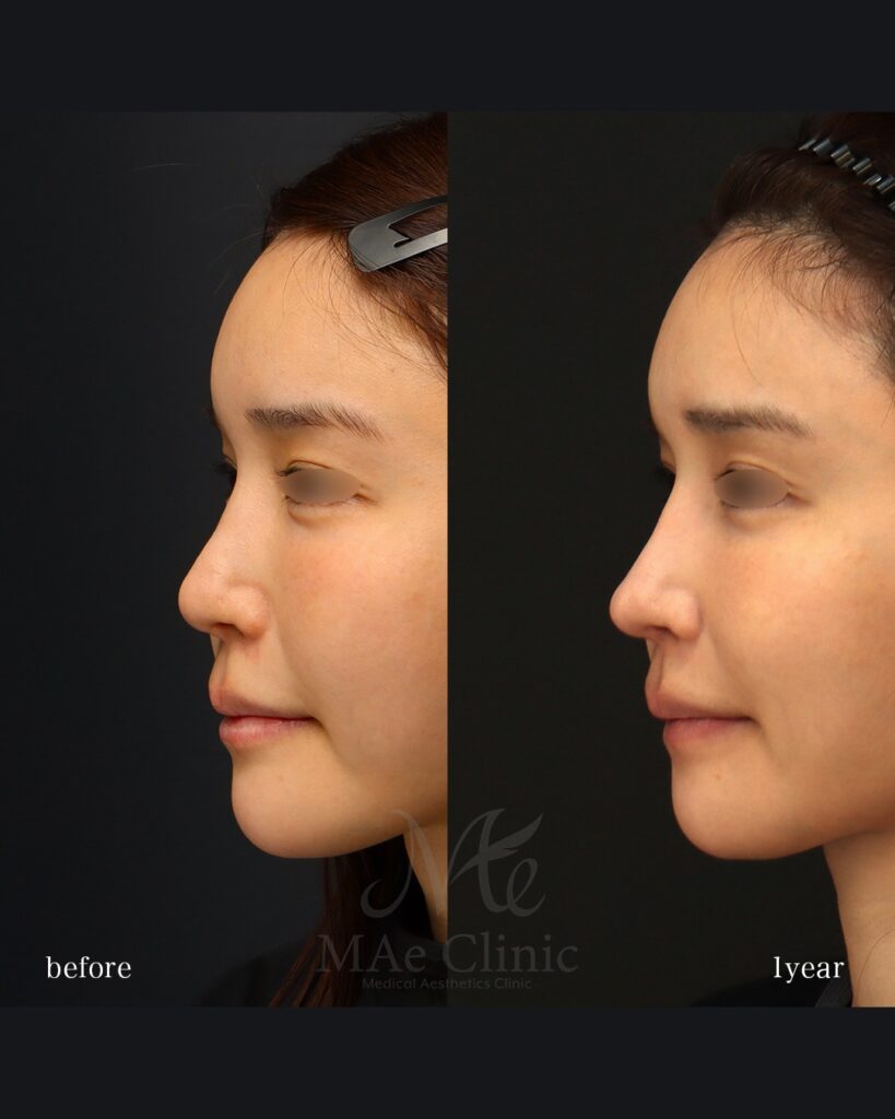 鼻中隔延長（肋軟骨） 鼻尖形成 鼻尖軟骨移植 隆鼻（肋軟骨） 鼻孔縁下降 猫貴族手術 前田翔医師症例写真