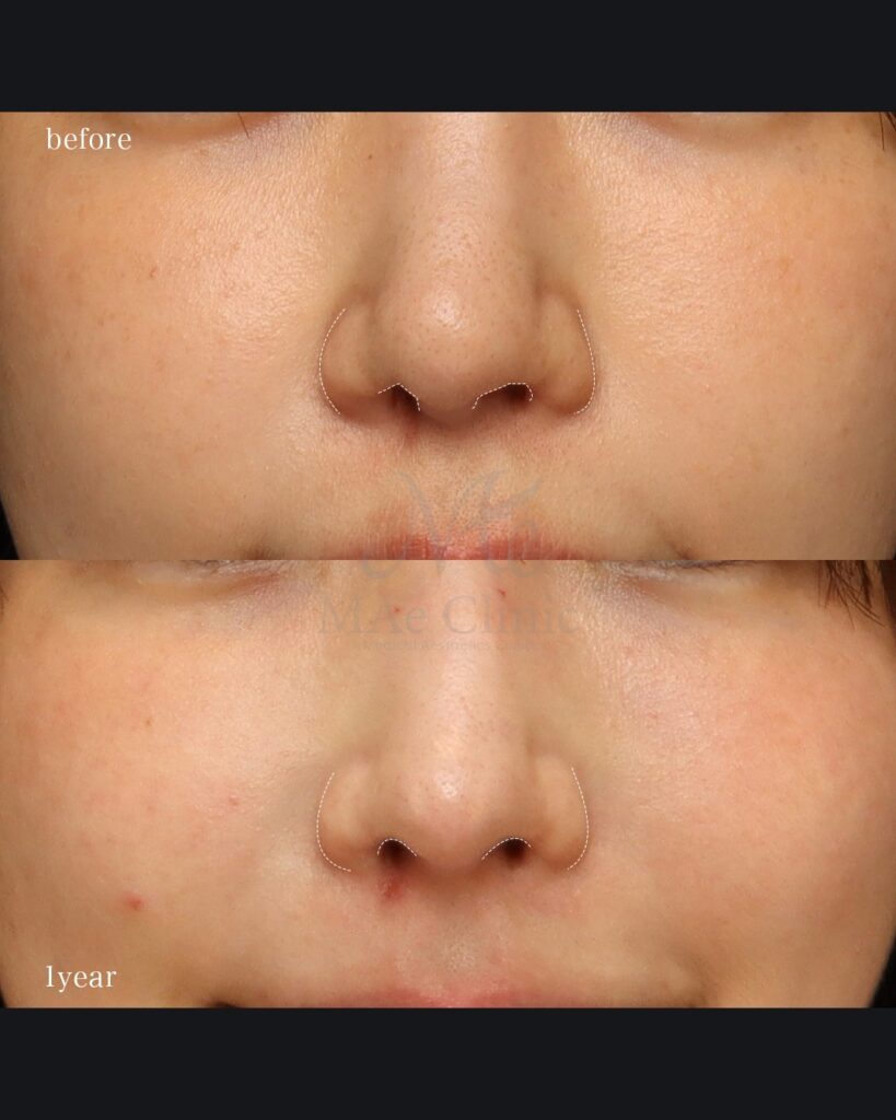 鼻中隔延長（肋軟骨） 鼻尖形成 鼻尖軟骨移植 隆鼻（肋軟骨） 鼻孔縁下降 猫貴族手術 前田翔医師症例写真