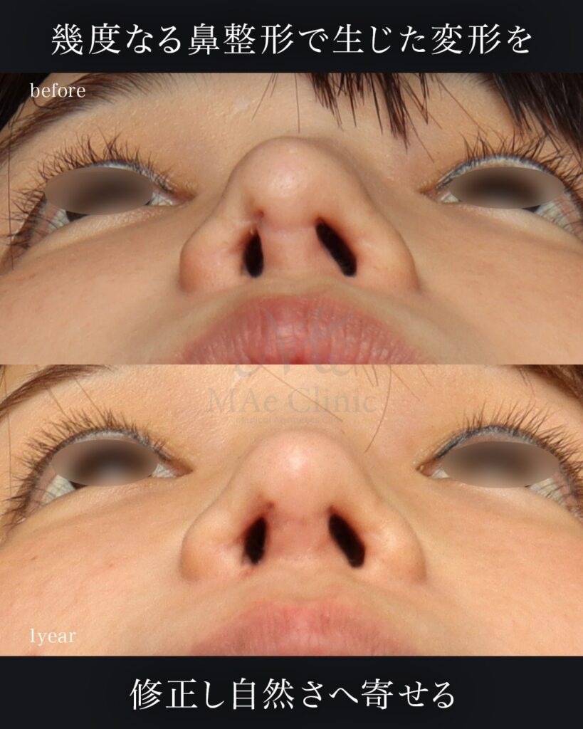 鼻中隔延長（肋軟骨） 鼻尖形成 鼻尖軟骨移植 隆鼻（肋軟骨） 鼻孔縁下降 猫貴族手術 前田翔医師症例写真