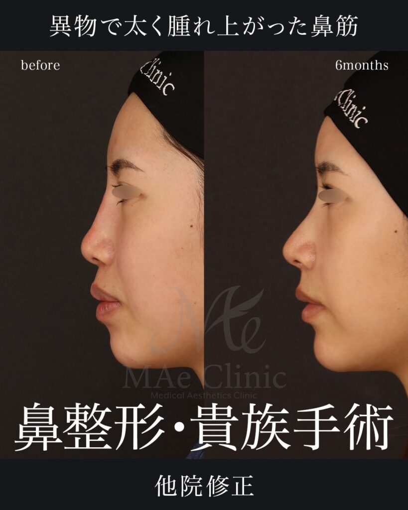鼻中隔延長(肋軟骨)
鼻尖形成
鼻尖軟骨移植
貴族手術
前田翔医師症例