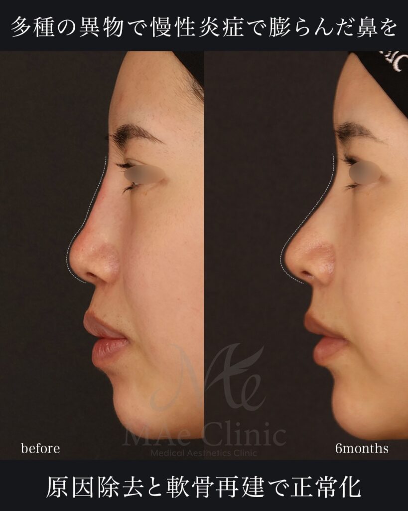 鼻中隔延長(肋軟骨) 鼻尖形成 鼻尖軟骨移植 貴族手術 前田翔医師症例