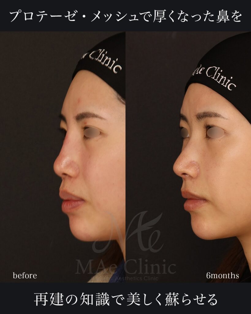鼻中隔延長(肋軟骨) 鼻尖形成 鼻尖軟骨移植 貴族手術 前田翔医師症例