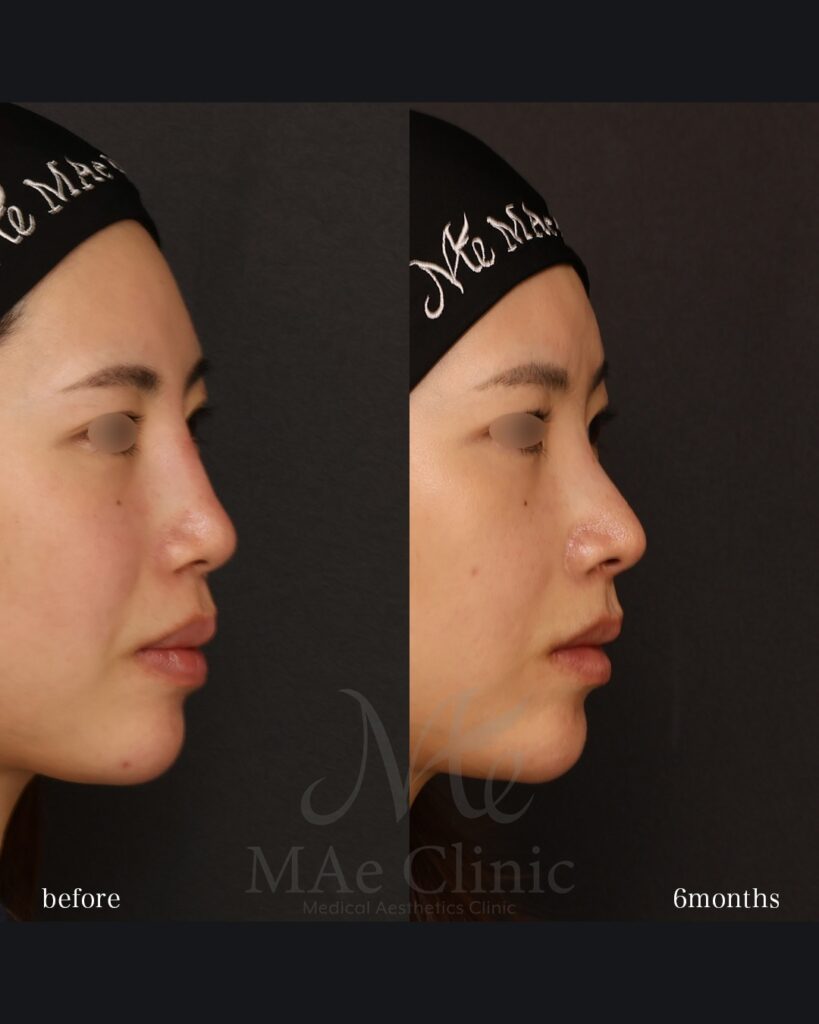 鼻中隔延長(肋軟骨) 鼻尖形成 鼻尖軟骨移植 貴族手術 前田翔医師症例