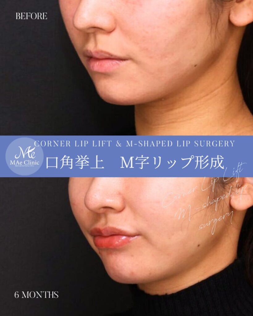 口角挙上 M字リップ形成 木下恵里沙医師症例