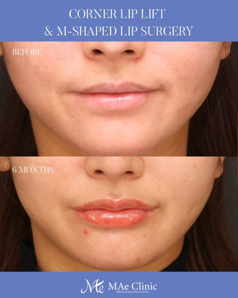 口角挙上 M字リップ形成 木下恵里沙医師症例