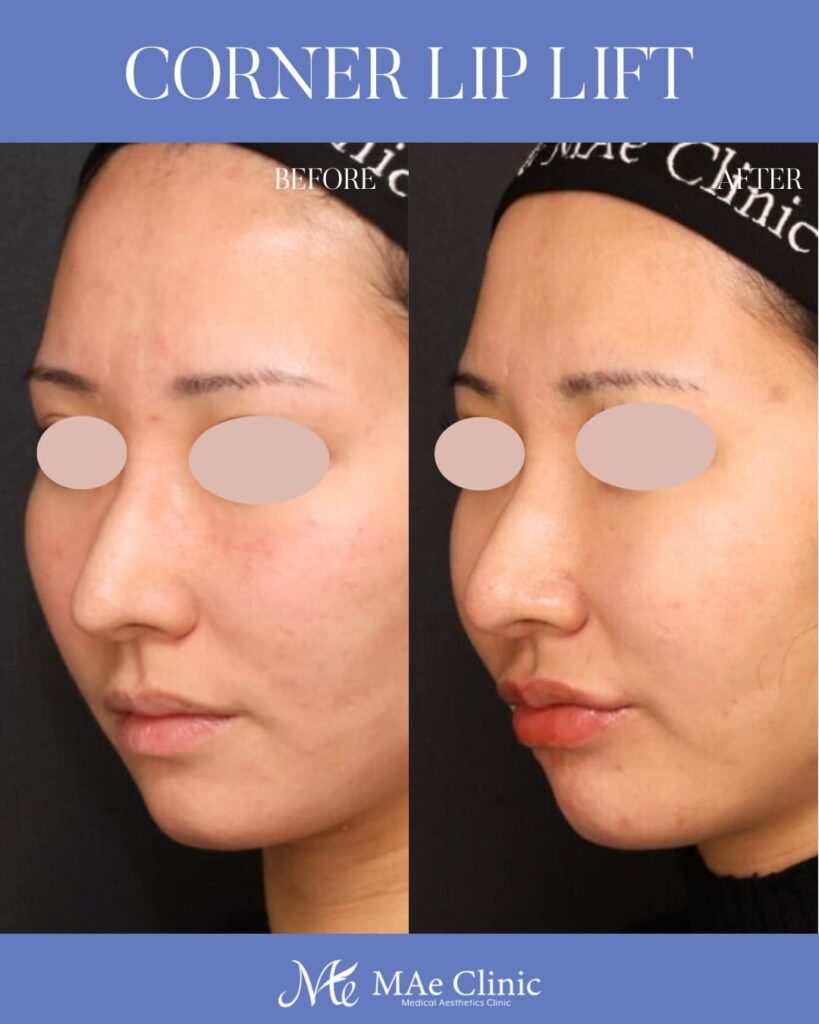 口角挙上 M字リップ形成 木下恵里沙医師症例