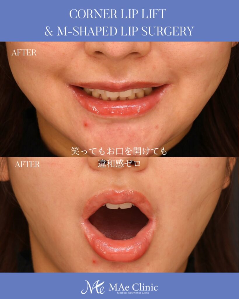 口角挙上 M字リップ形成 木下恵里沙医師症例