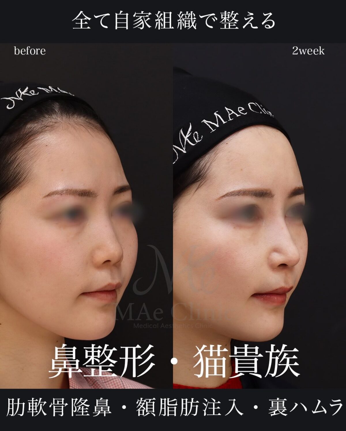 鼻先形成と脂肪注入・裏ハムラで顔全体を整えた症例｜望月正人医師