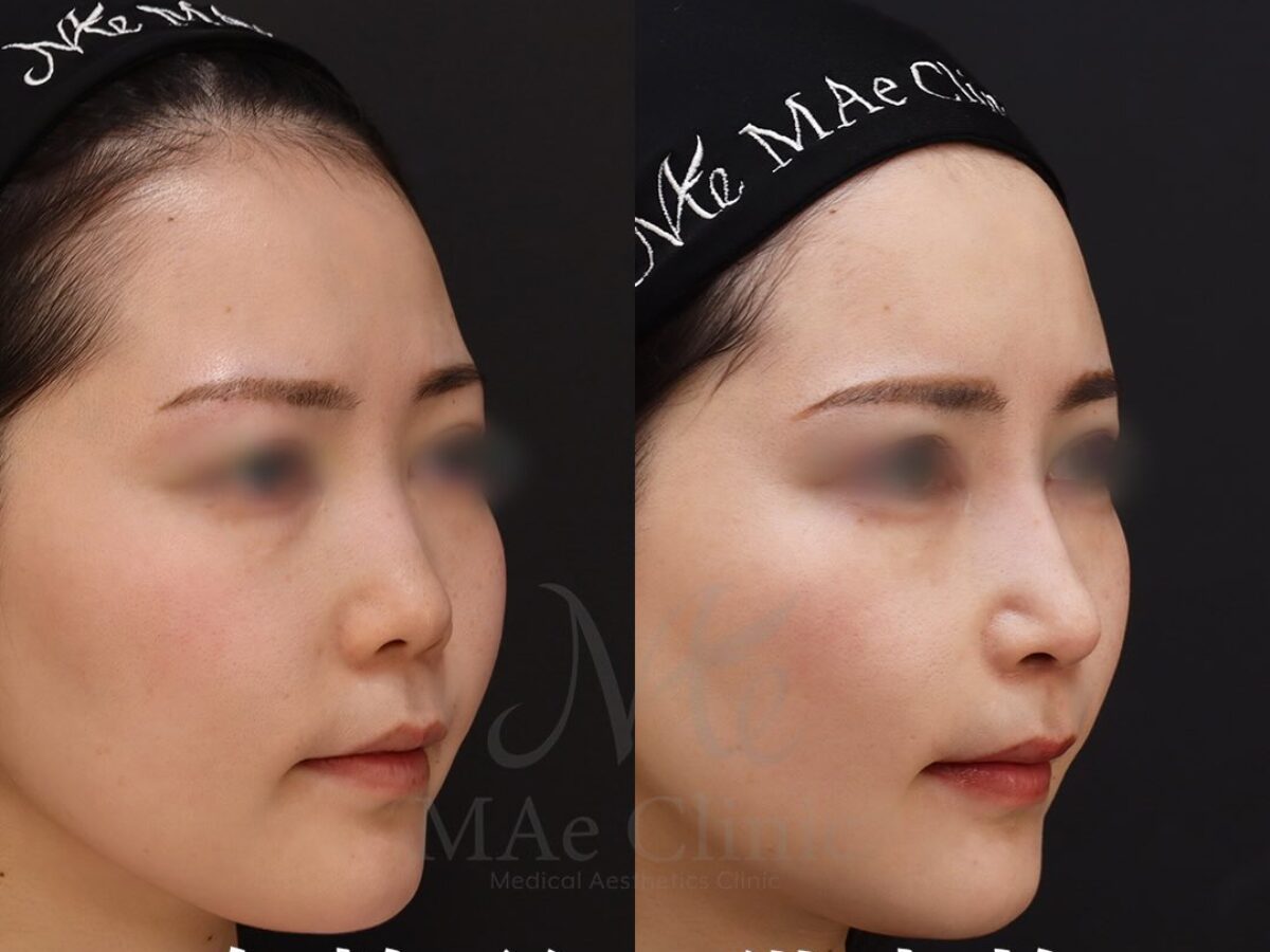 鼻先形成と脂肪注入・裏ハムラで顔全体を整えた症例｜望月正人医師