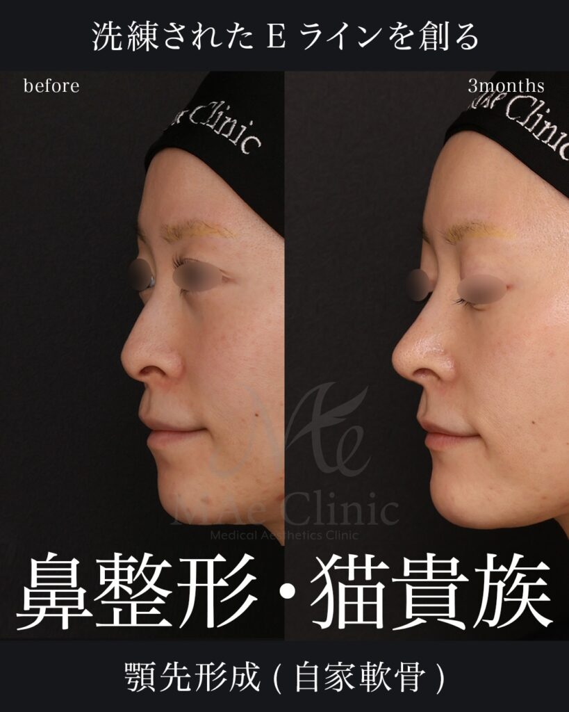 鼻中隔延長（肋軟骨） 鼻尖形成 鼻尖軟骨移植 猫貴族手術 顎先軟骨移植 前田翔医師症例