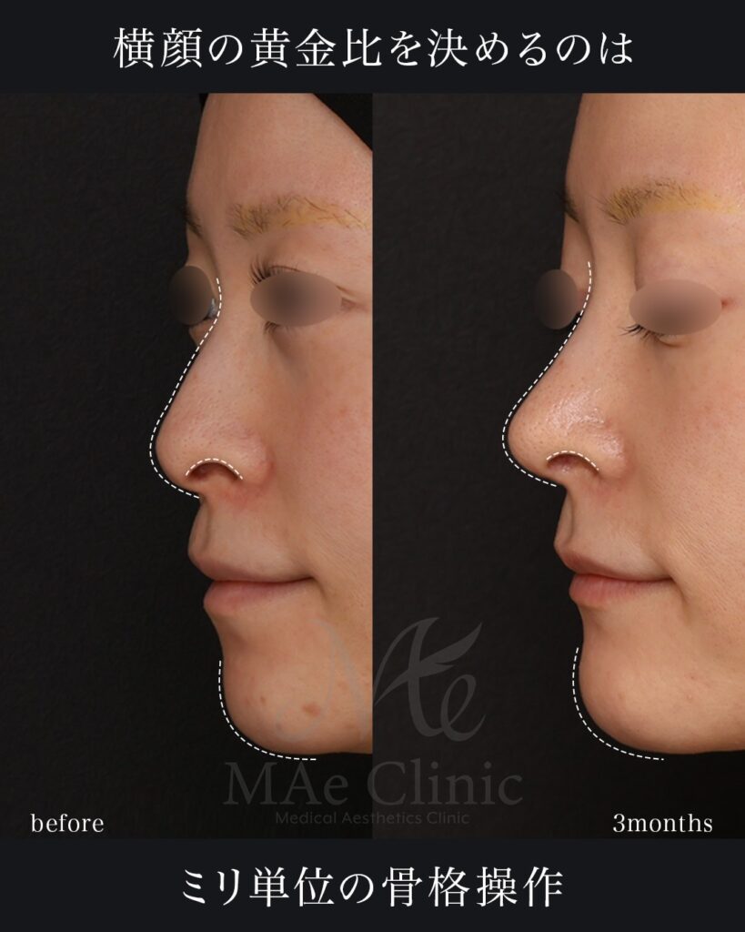 鼻中隔延長(肋軟骨) 鼻尖形成 鼻尖軟骨移植 猫貴族手術 顎先軟骨移植 前田翔医師症例