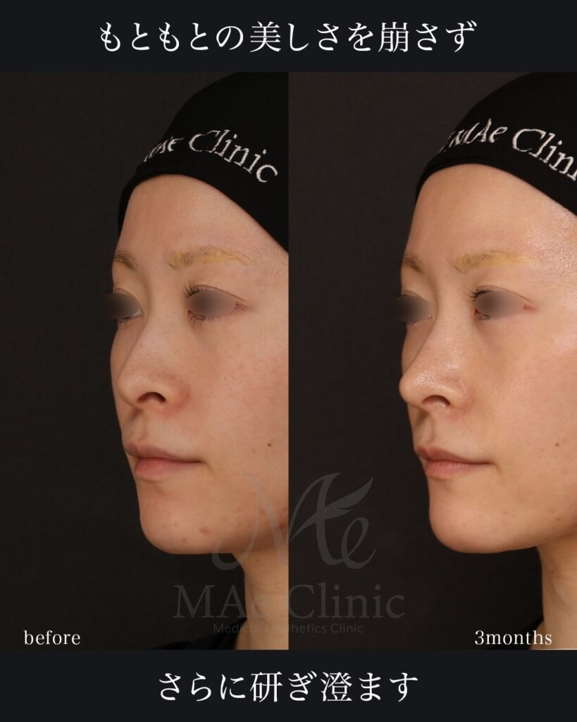 鼻中隔延長(肋軟骨) 鼻尖形成 鼻尖軟骨移植 猫貴族手術 顎先軟骨移植 前田翔医師症例