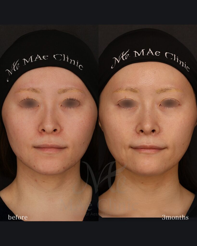 鼻中隔延長(肋軟骨) 鼻尖形成 鼻尖軟骨移植 猫貴族手術 顎先軟骨移植 前田翔医師症例