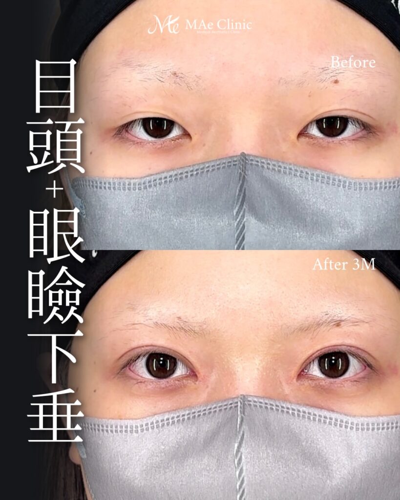 眼瞼下垂手術（挙筋前転術）
目頭切開（リドレープ法）前之園健太医師症例