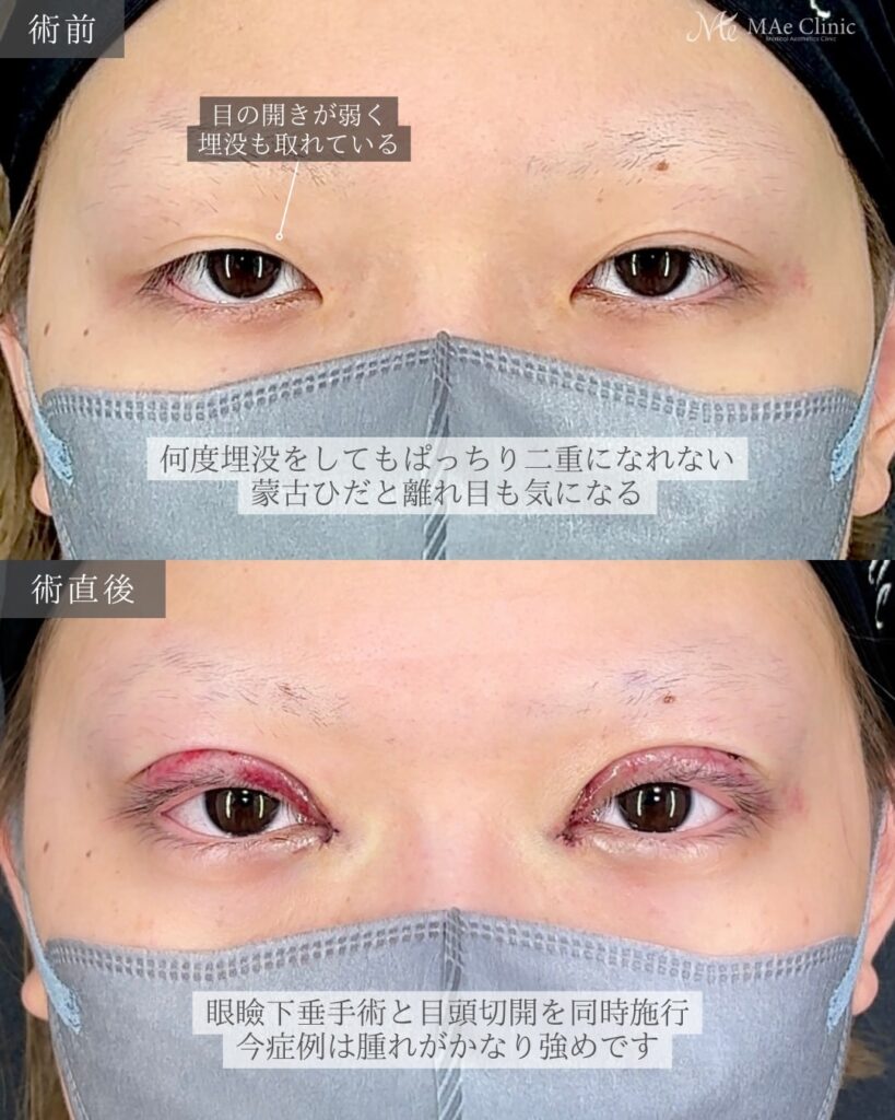 眼瞼下垂手術（挙筋前転術） 目頭切開（リドレープ法）前之園健太医師症例