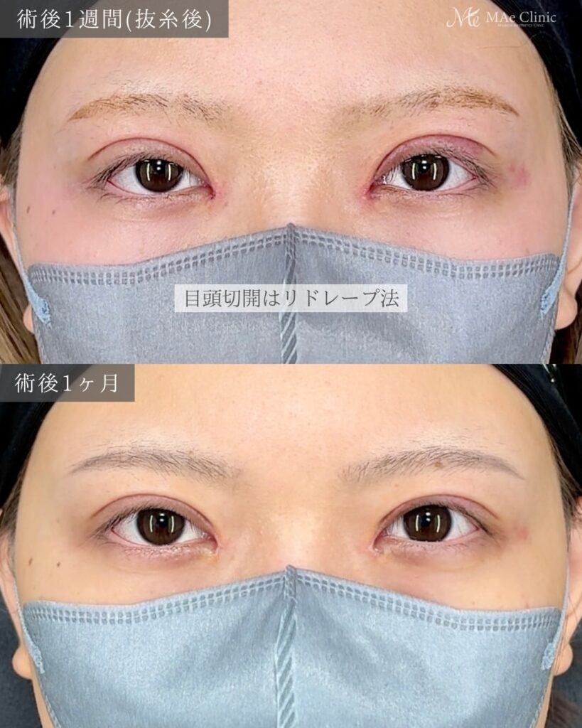 眼瞼下垂手術（挙筋前転術） 目頭切開（リドレープ法）前之園健太医師症例