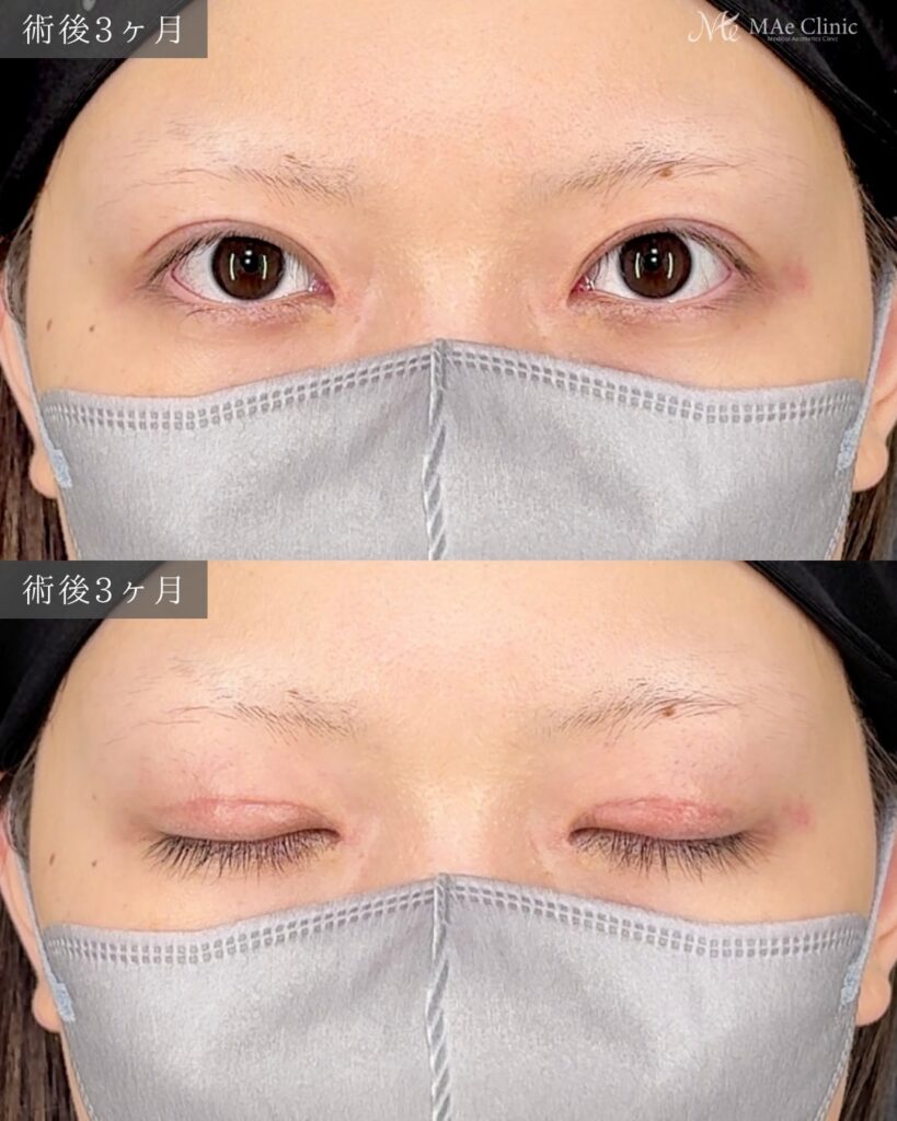 眼瞼下垂手術（挙筋前転術） 目頭切開（リドレープ法）前之園健太医師症例