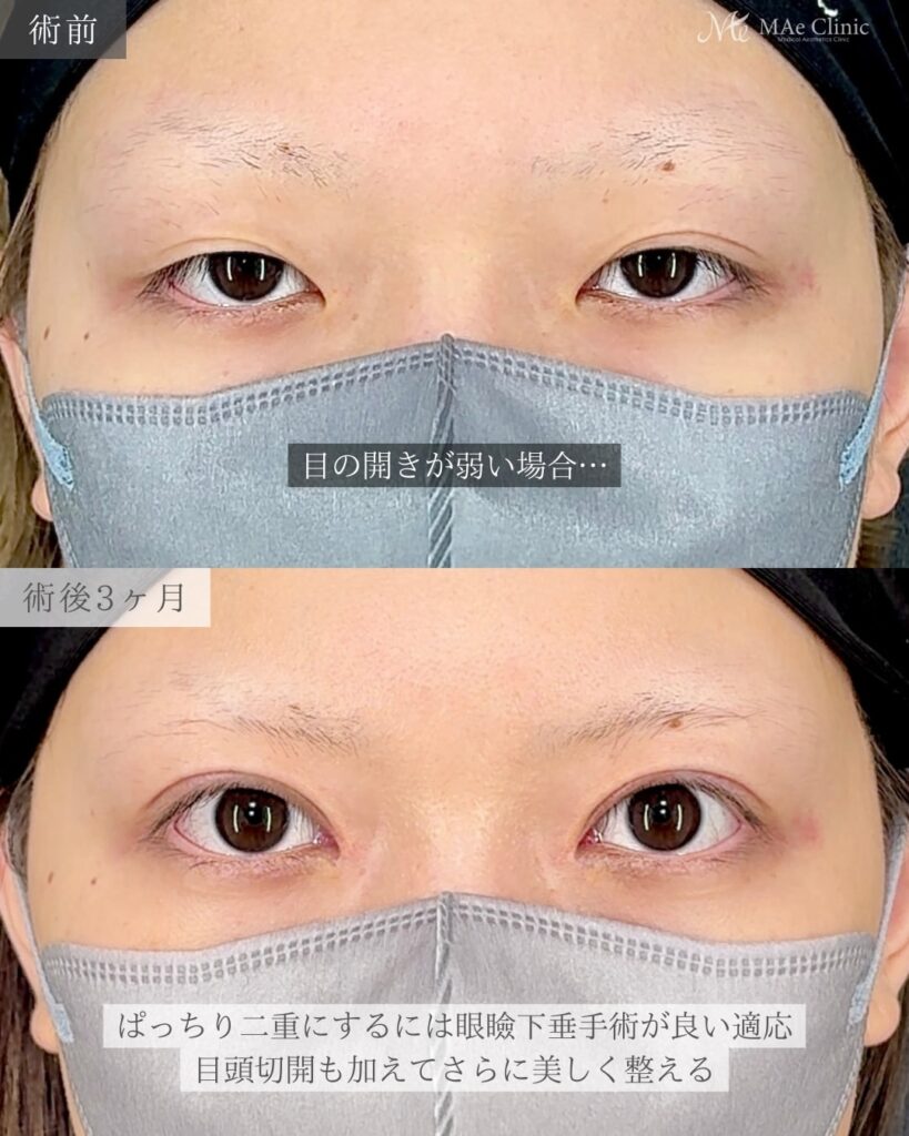 眼瞼下垂手術（挙筋前転術） 目頭切開（リドレープ法）前之園健太医師症例