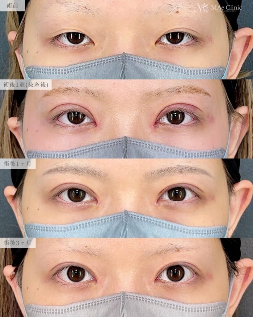 眼瞼下垂手術（挙筋前転術） 目頭切開（リドレープ法）前之園健太医師症例