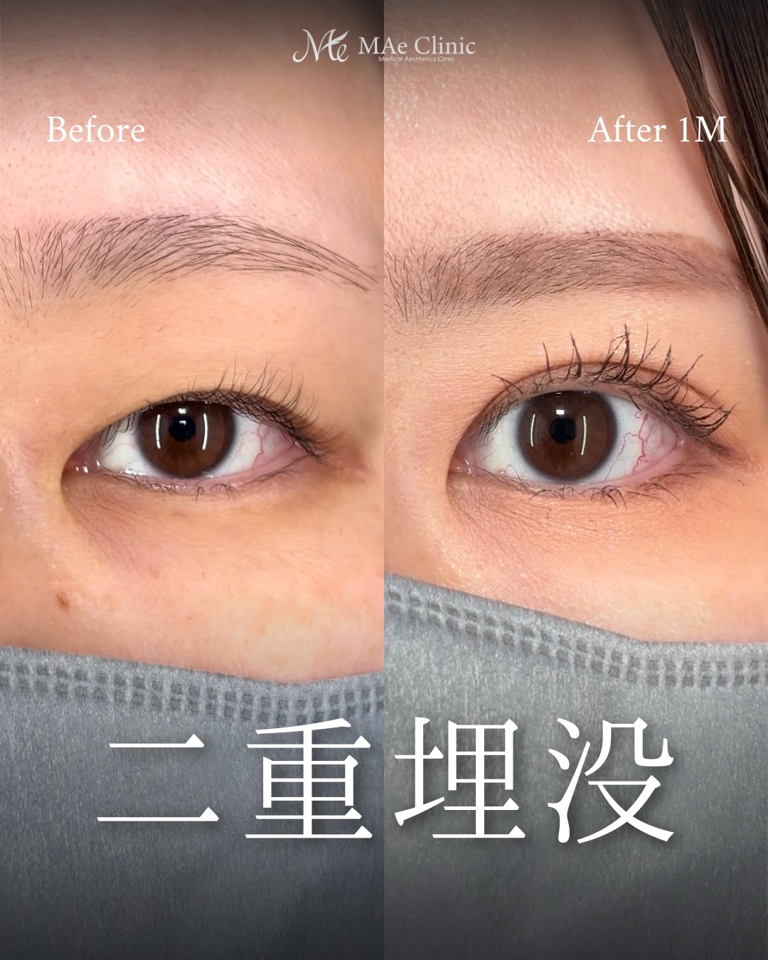 長年のアイプチで作りにくくなった二重を埋没で整えた症例：前之園健太