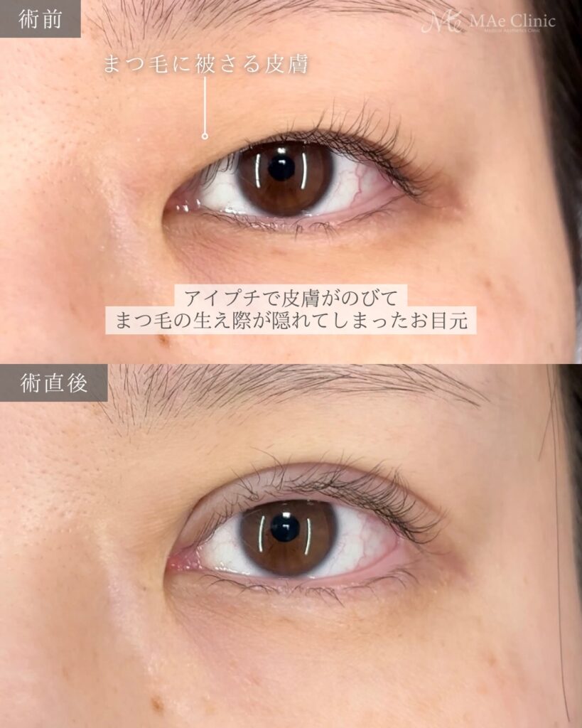 二重埋没（裏留め2ループ）前之園健太医師症例