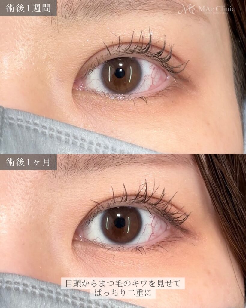 二重埋没（裏留め2ループ）前之園健太医師症例