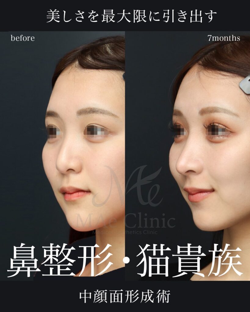 鼻中隔延長（肋軟骨）
鼻尖形成
鼻尖軟骨移植
ハンプ修正
猫貴族手術（肋軟骨）
脂肪注入（額）
前田翔医師症例