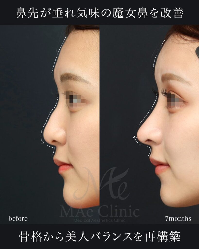 鼻中隔延長（肋軟骨） 鼻尖形成 鼻尖軟骨移植 ハンプ修正 猫貴族手術（肋軟骨） 脂肪注入（額） 前田翔医師症例