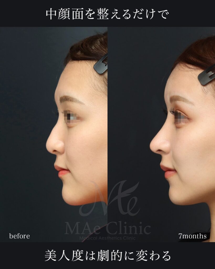 鼻中隔延長（肋軟骨） 鼻尖形成 鼻尖軟骨移植 ハンプ修正 猫貴族手術（肋軟骨） 脂肪注入（額） 前田翔医師症例