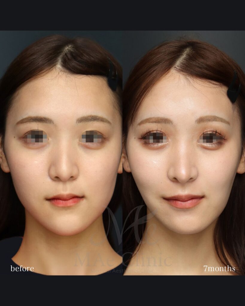 鼻中隔延長（肋軟骨） 鼻尖形成 鼻尖軟骨移植 ハンプ修正 猫貴族手術（肋軟骨） 脂肪注入（額） 前田翔医師症例