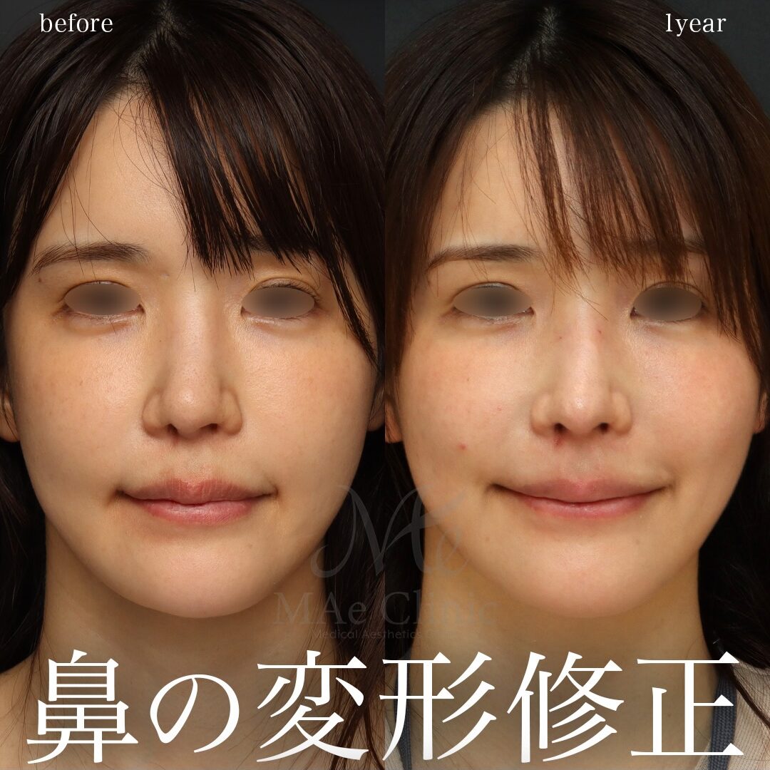 ガチガチに固まった「拘縮鼻」をどう治すか｜瘢痕解除と肋軟骨による他