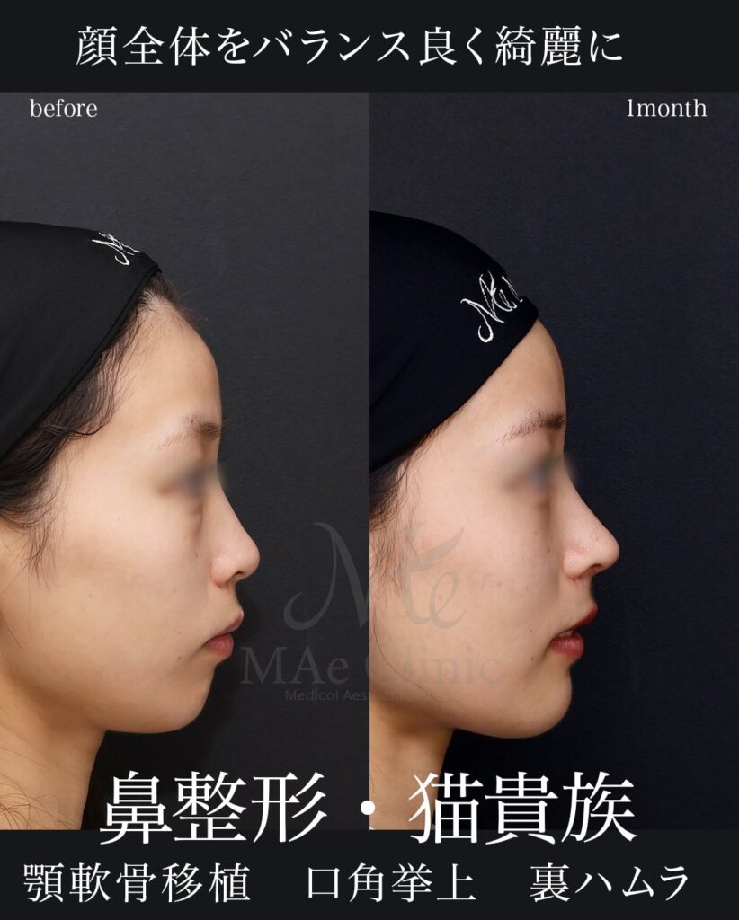鼻中隔延長（肋軟骨） 猫貴族手術 顎先軟骨移植 裏ハムラ法 口角挙上（右側）望月正人医師症例