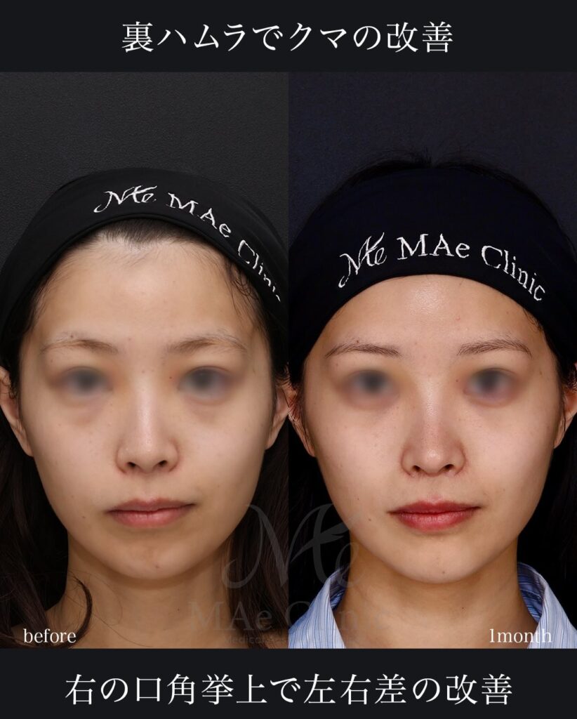 鼻中隔延長（肋軟骨） 猫貴族手術 顎先軟骨移植 裏ハムラ法 口角挙上（右側）望月正人医師症例