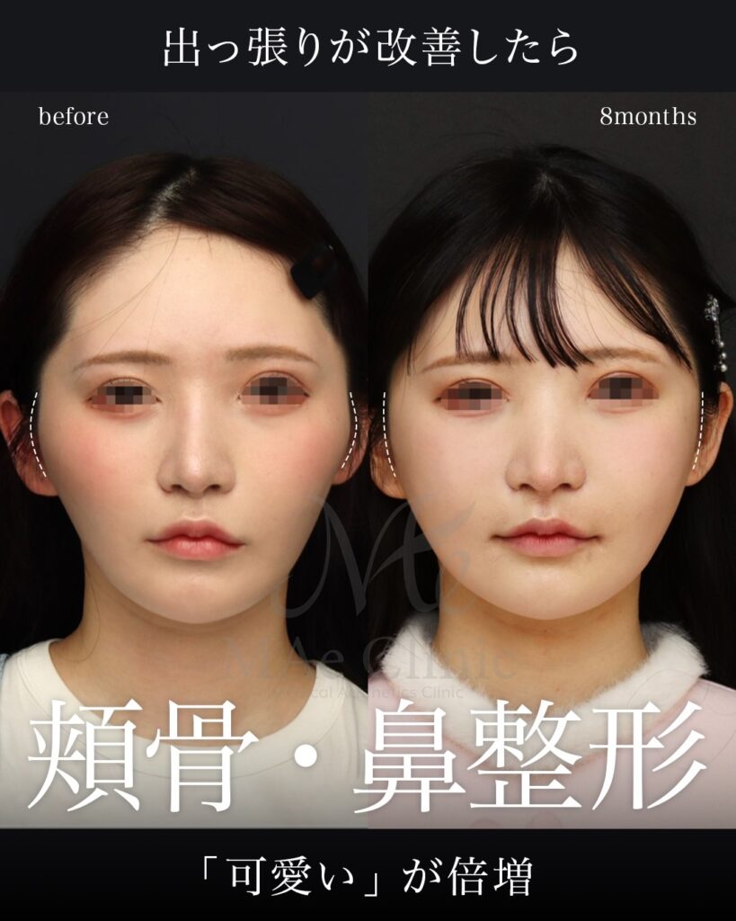 他院修正、鼻中隔延長、鼻尖形成、梨状口縁細片軟骨移植（猫貴族手術）、鼻背プロテーゼ除去、隆鼻、材料は全て肋軟骨、鼻骨骨切り　8ヶ月
頬骨骨切りアーチインフラクチャー、鼻翼縮小　1ヶ月
前田翔医師症例