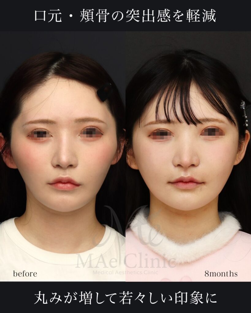 他院修正、鼻中隔延長、鼻尖形成、梨状口縁細片軟骨移植（猫貴族手術）、鼻背プロテーゼ除去、隆鼻、材料は全て肋軟骨、鼻骨骨切り　8ヶ月 頬骨骨切りアーチインフラクチャー、鼻翼縮小　1ヶ月 前田翔医師症例