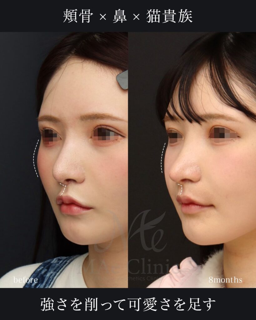 他院修正、鼻中隔延長、鼻尖形成、梨状口縁細片軟骨移植（猫貴族手術）、鼻背プロテーゼ除去、隆鼻、材料は全て肋軟骨、鼻骨骨切り　8ヶ月 頬骨骨切りアーチインフラクチャー、鼻翼縮小　1ヶ月 前田翔医師症例