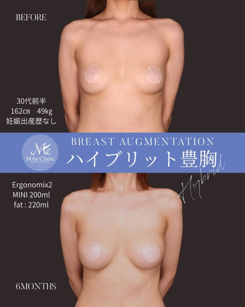 ハイブリッド豊胸 (Motiva Ergonomix2 200cc + 脂肪注入 右110ml・左110ml Total 220ml)木下恵里沙医師症例