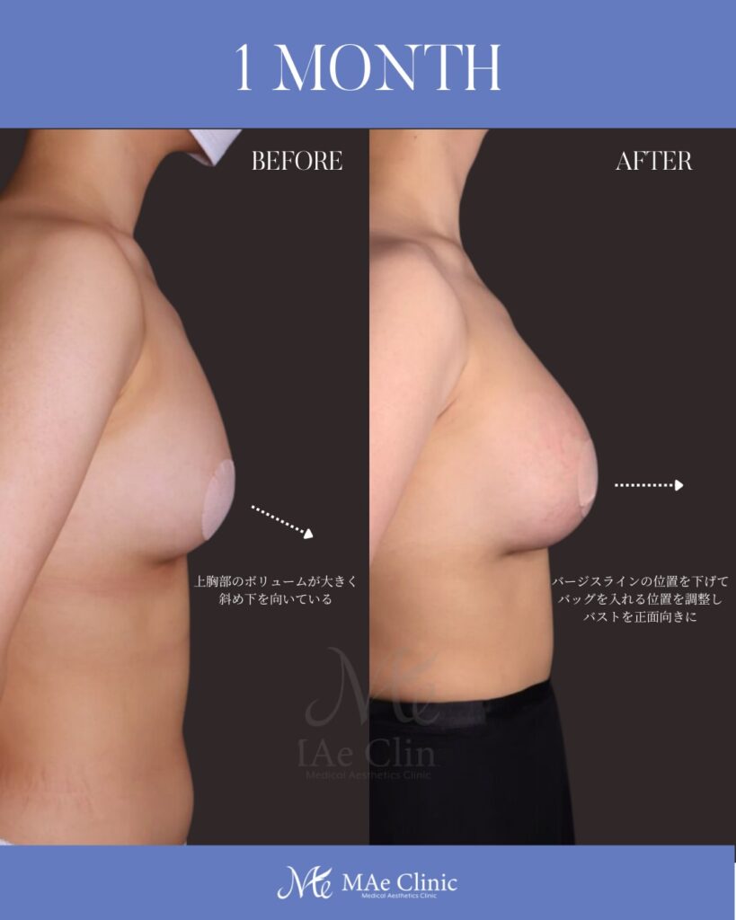 シリコンバック豊胸 （Motiva Ergonomix2：右250cc / 左200cc） アプローチ：乳房下溝切開 留置層：乳腺下　木下恵里沙医師症例