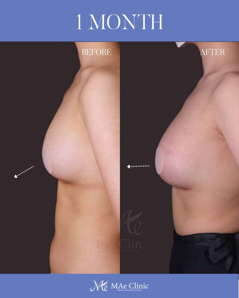 シリコンバック豊胸 （Motiva Ergonomix2：右250cc / 左200cc） アプローチ：乳房下溝切開 留置層：乳腺下　木下恵里沙医師症例