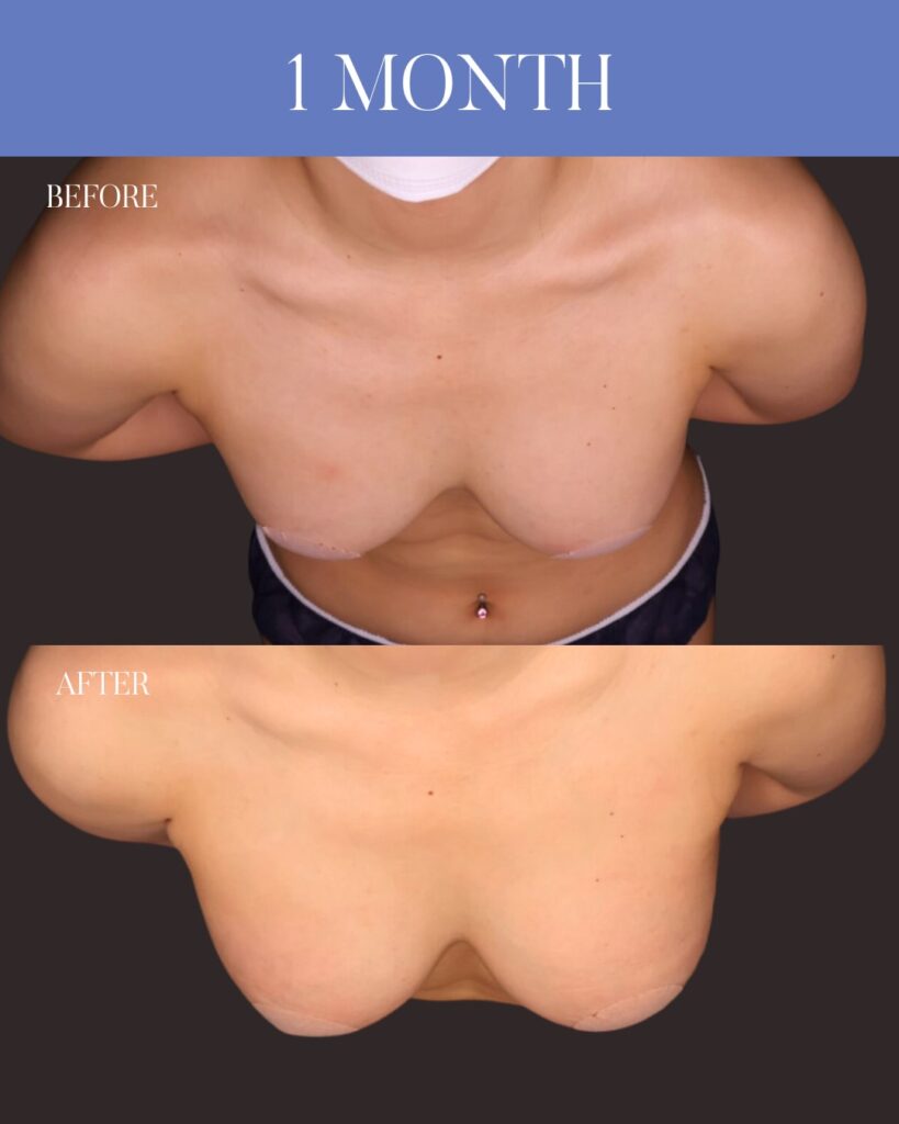 シリコンバック豊胸 （Motiva Ergonomix2：右250cc / 左200cc） アプローチ：乳房下溝切開 留置層：乳腺下　木下恵里沙医師症例