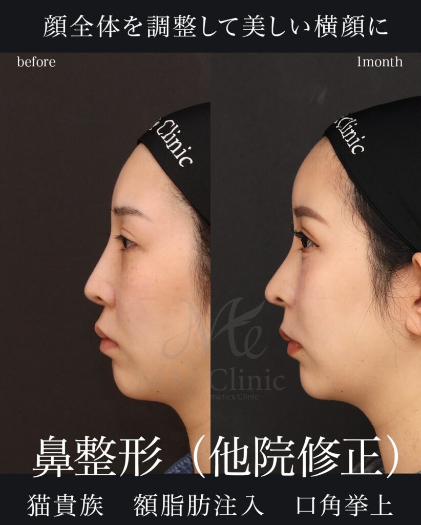 他院修正（鼻プロテーゼ抜去） 鼻尖形成（肋軟骨移植） 額脂肪注入 （全自家組織による再構築）望月正人医師症例