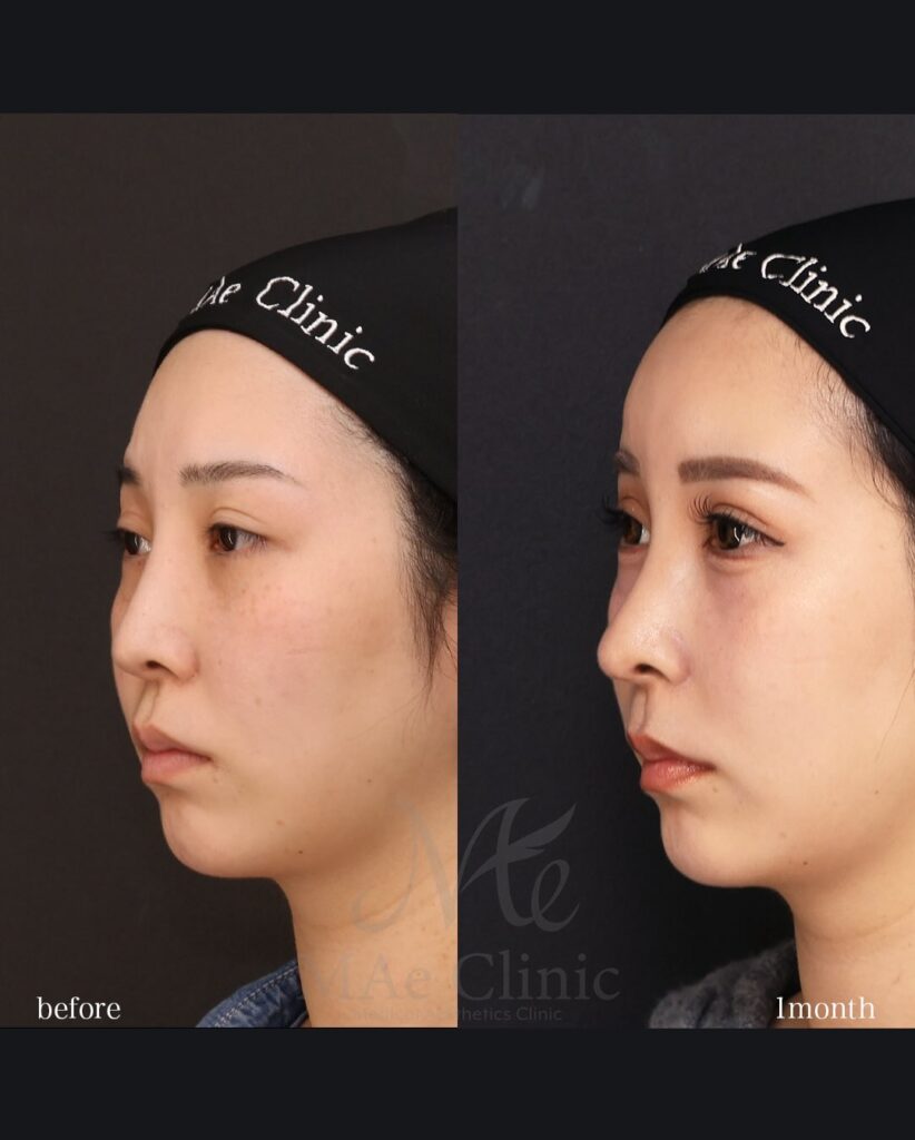 他院修正（鼻プロテーゼ抜去） 鼻尖形成（肋軟骨移植） 額脂肪注入 （全自家組織による再構築）望月正人医師症例