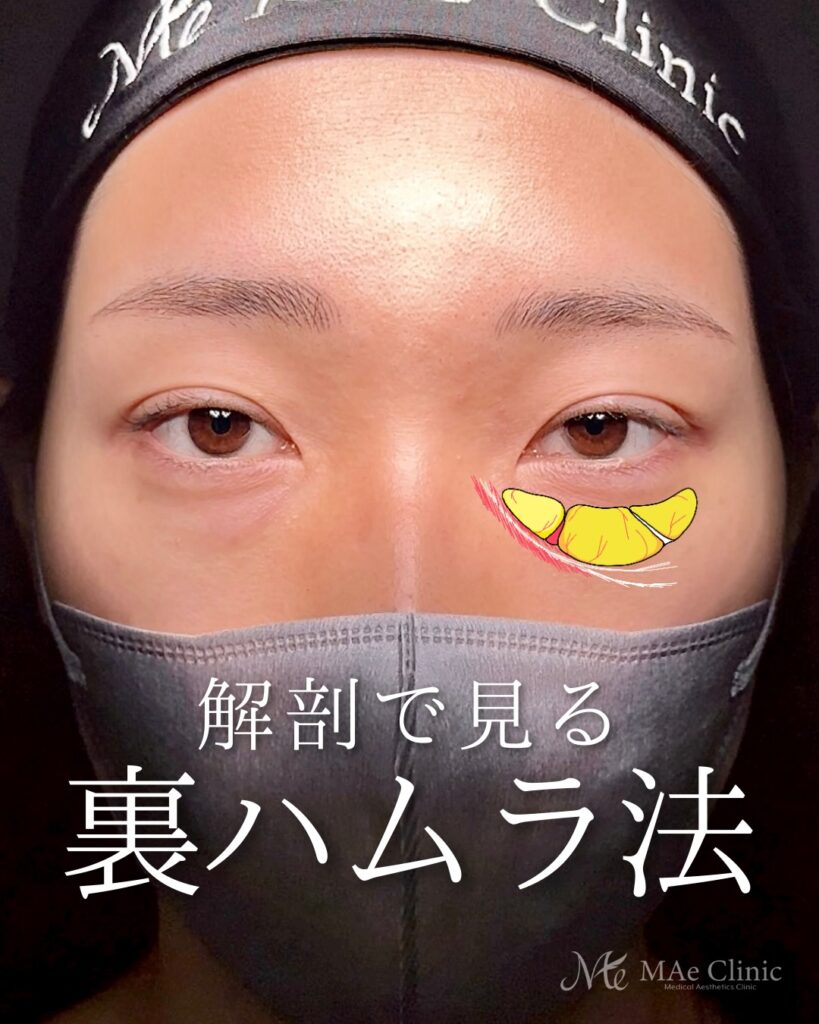 裏ハムラ法 (眼窩脂肪移動術・経結膜的眼窩脂肪移動術)前之園健太医師症例