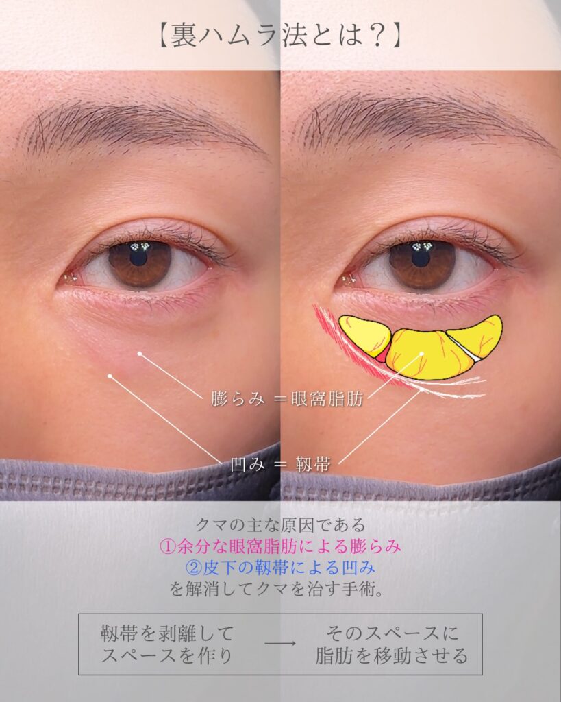 裏ハムラ法 (眼窩脂肪移動術・経結膜的眼窩脂肪移動術)前之園健太医師症例