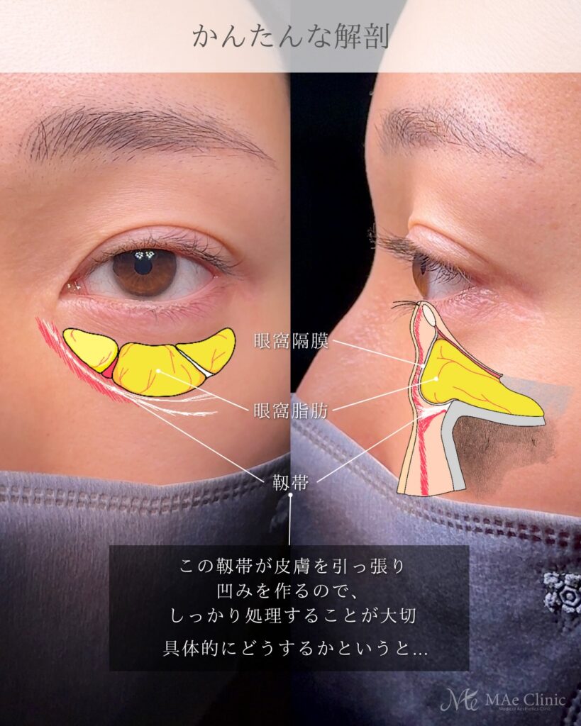 裏ハムラ法 (眼窩脂肪移動術・経結膜的眼窩脂肪移動術)前之園健太医師症例