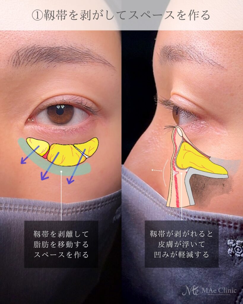 裏ハムラ法 (眼窩脂肪移動術・経結膜的眼窩脂肪移動術)前之園健太医師症例