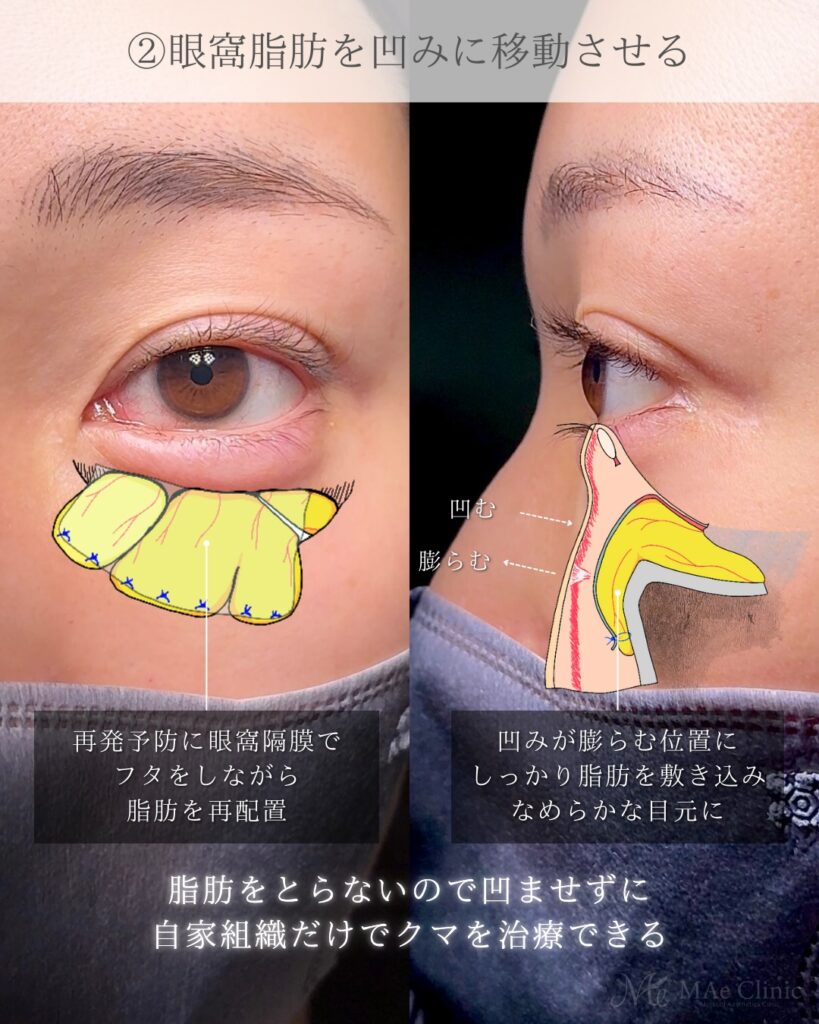 裏ハムラ法 (眼窩脂肪移動術・経結膜的眼窩脂肪移動術)前之園健太医師症例